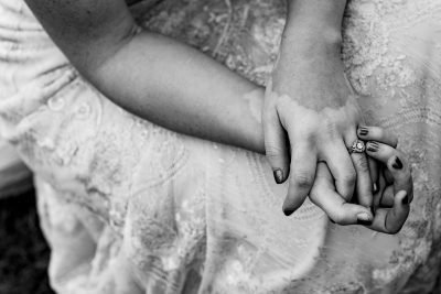 Lo Potter's hands with vitiligo